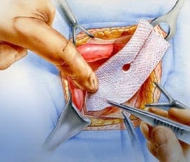 Plastia inguinal abierta 