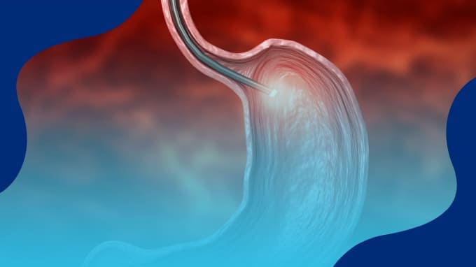 Precio de Endoscopia