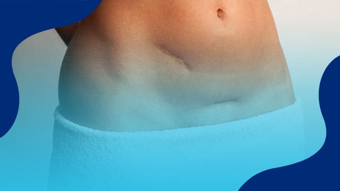 Precio de operación de Hernia Inguinal