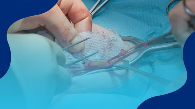 Precio de operación de Hernia Inguinal